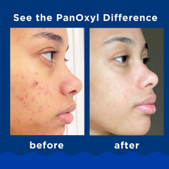 PanOxyl Acne Foaming Wash - 156g PanOxyl