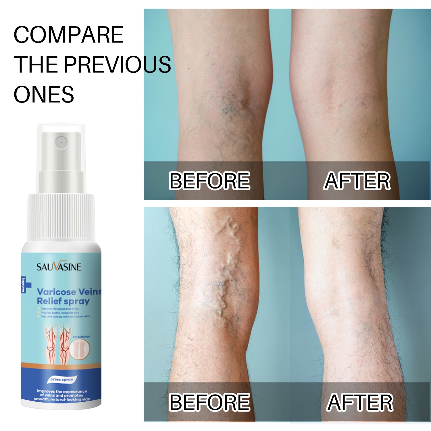 Sauvasine Varicose Veins Relief Spray - 30ml Sauvasine