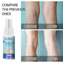 Sauvasine Varicose Veins Relief Spray - 30ml Sauvasine