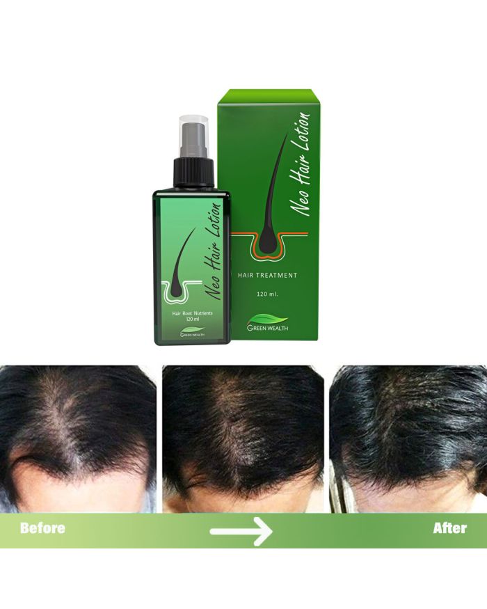 Neo Hair Lotion - 120ml Neo