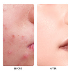 Skinever Salicylic Acid Refreshing Acne Soap - 80g