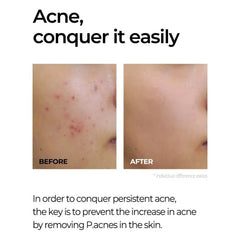 Some By Mi MIRACLE AC CLEAR SPOT TREATMENT - 10g SOME BY MI