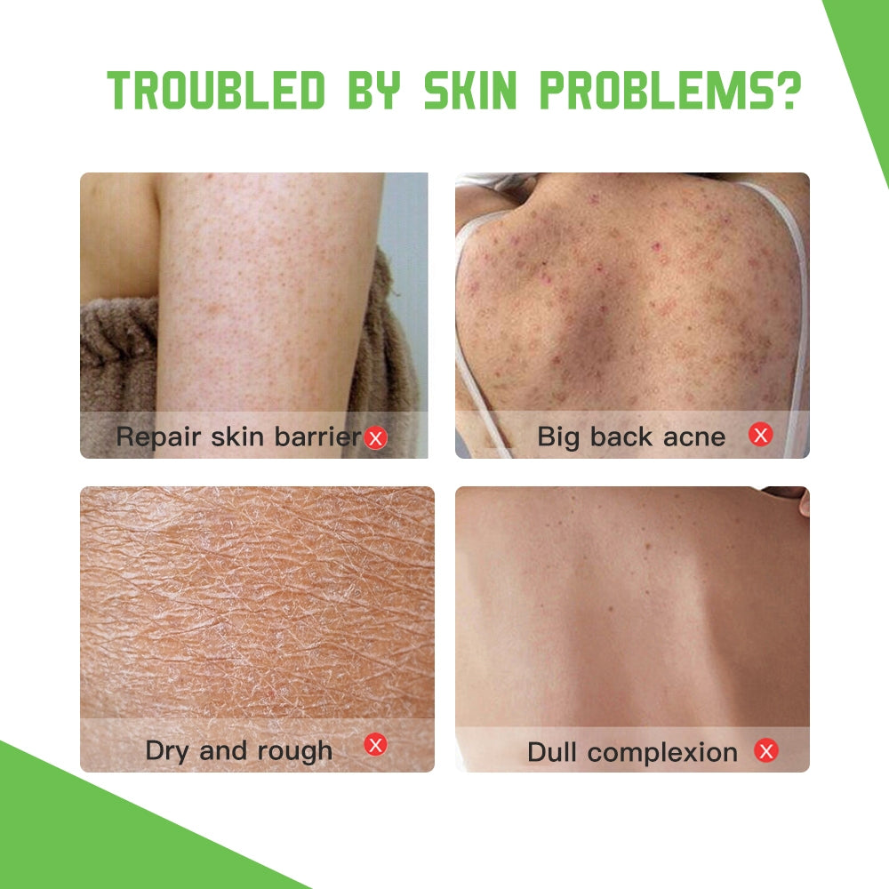Disaar SA Anti-Acne Body Lotion - 300g Disaar